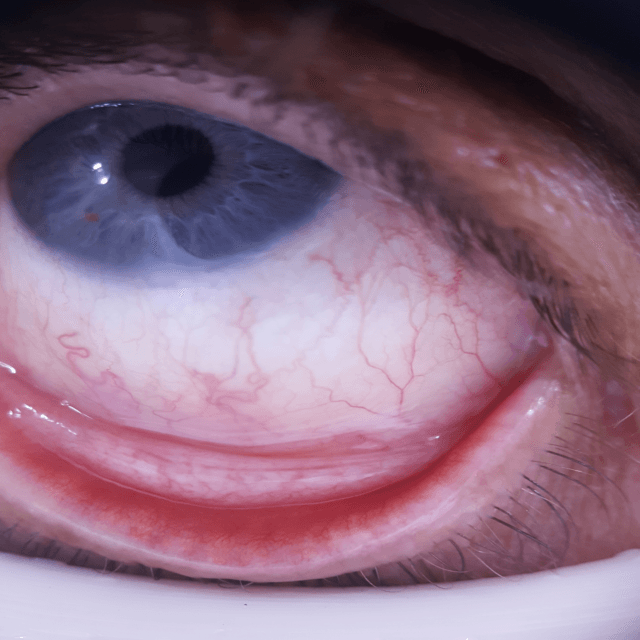 Close-up eye image used for anemia screening.